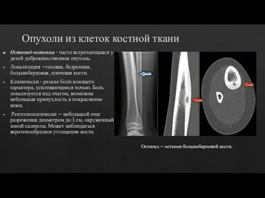 Опухоли из клеток костной ткани Остеоид-остеома - часто встречающаяся у детей