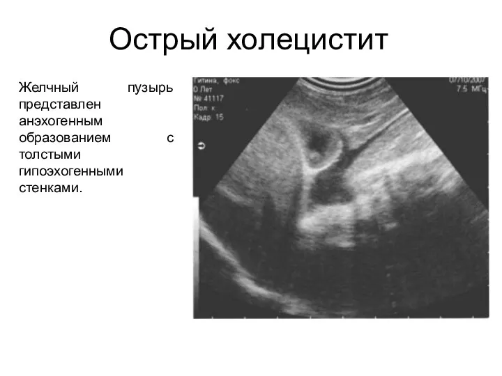 Острый холецистит Желчный пузырь представлен анэхогенным образованием с толстыми гипоэхогенными стенками.