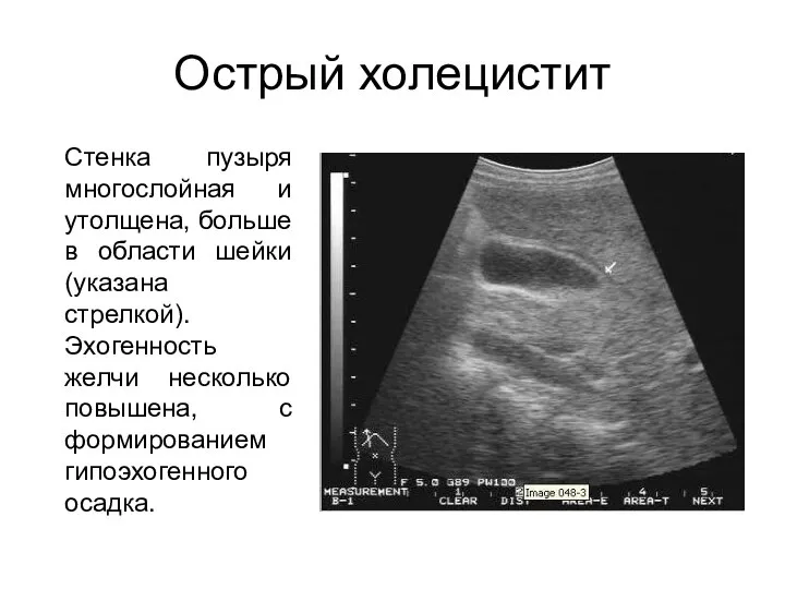 Острый холецистит Стенка пузыря многослойная и утолщена, больше в области шейки