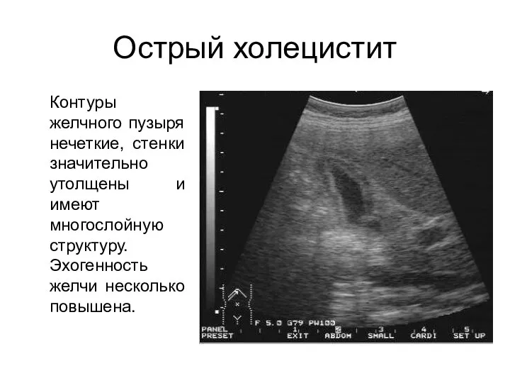 Острый холецистит Контуры желчного пузыря нечеткие, стенки значительно утолщены и имеют