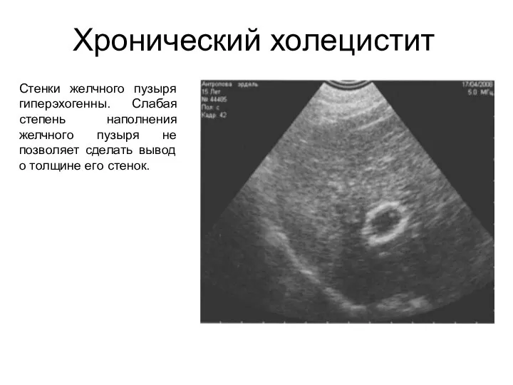 Хронический холецистит Стенки желчного пузыря гиперэхогенны. Слабая степень наполнения желчного пузыря