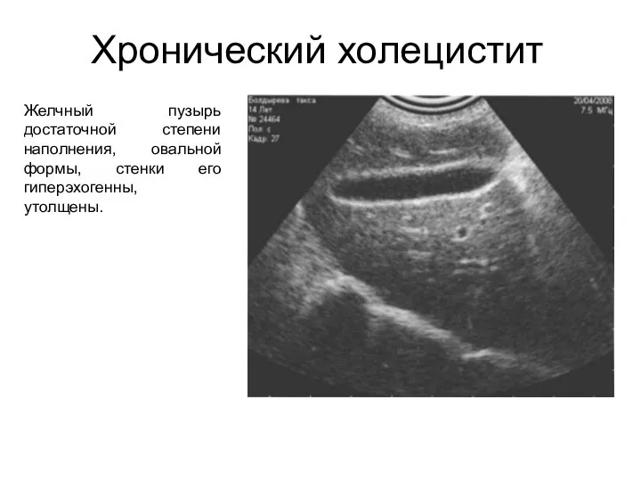 Хронический холецистит Желчный пузырь достаточной степени наполнения, овальной формы, стенки его гиперэхогенны, утолщены.