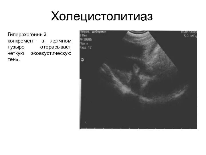 Холецистолитиаз Гиперэхогенный конкремент в желчном пузыре отбрасывает четкую эхоакустическую тень.