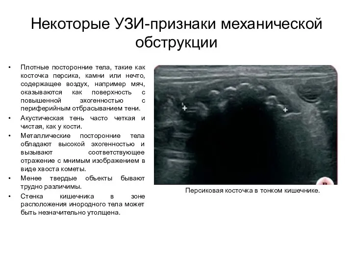 Некоторые УЗИ-признаки механической обструкции Плотные посторонние тела, такие как косточка персика,