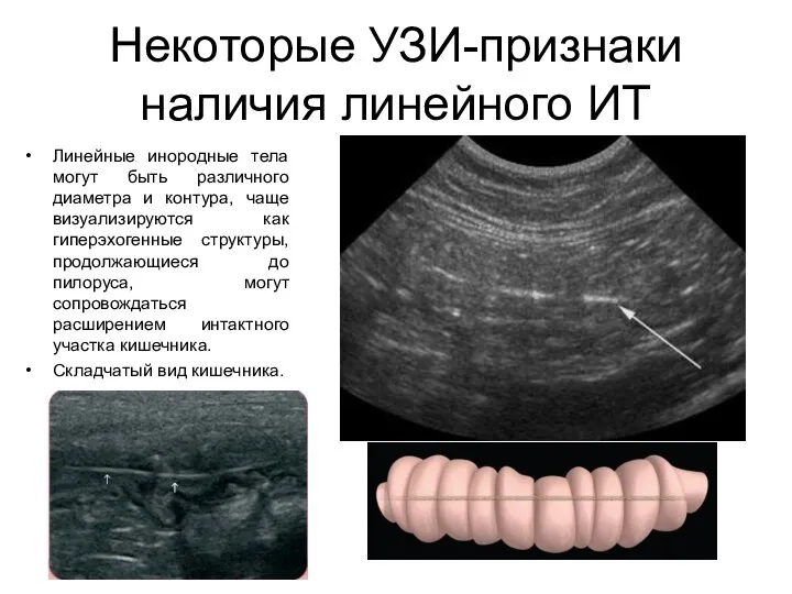 Некоторые УЗИ-признаки наличия линейного ИТ Линейные инородные тела могут быть различного