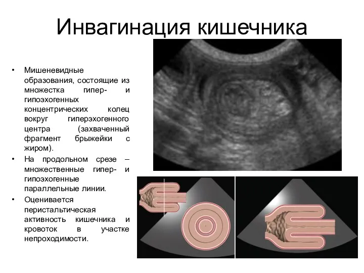 Инвагинация кишечника Мишеневидные образования, состоящие из множестка гипер- и гипоэхогенных концентрических