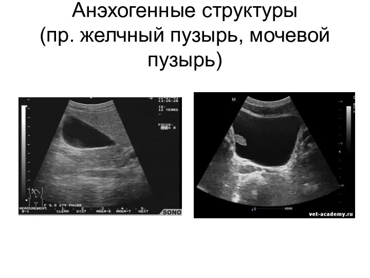 Анэхогенные структуры (пр. желчный пузырь, мочевой пузырь)