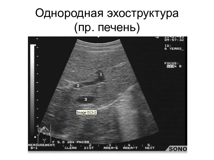 Однородная эхоструктура (пр. печень)