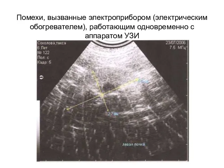 Помехи, вызванные электроприбором (электрическим обогревателем), работающим одновременно с аппаратом УЗИ