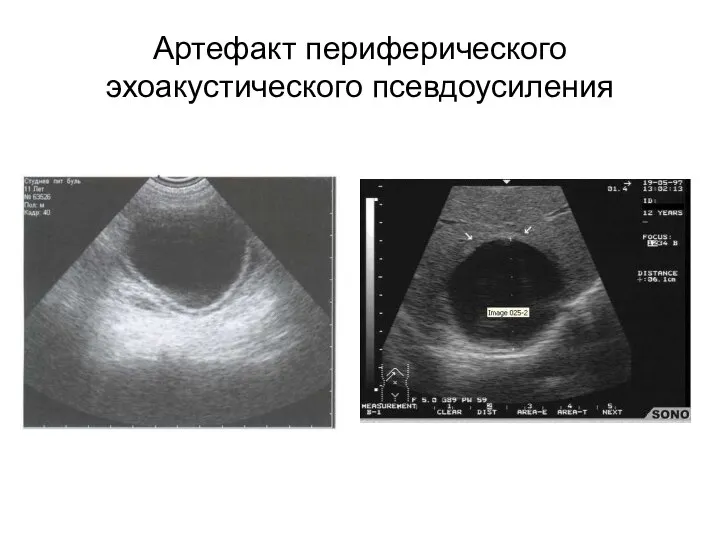 Артефакт периферического эхоакустического псевдоусиления