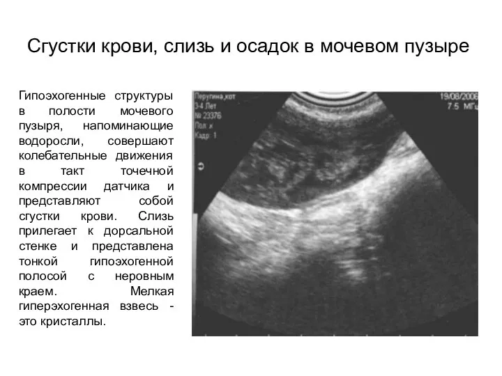 Сгустки крови, слизь и осадок в мочевом пузыре Гипоэхогенные структуры в