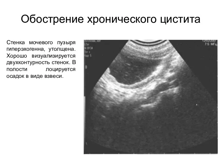 Обострение хронического цистита Стенка мочевого пузыря гиперэхогенна, утолщена. Хорошо визуализируется двухконтурность