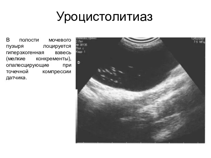 Уроцистолитиаз В полости мочевого пузыря лоцируется гиперэхогенная взвесь (мелкие конкременты), опалесцирующие при точечной компрессии датчика.