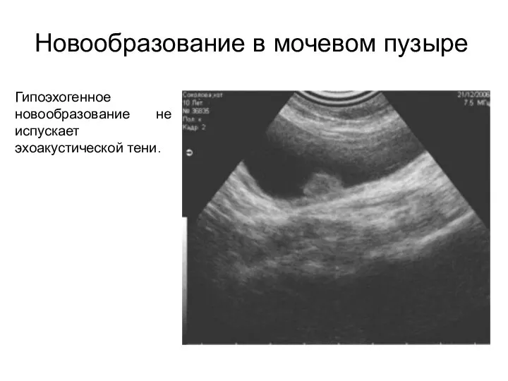 Новообразование в мочевом пузыре Гипоэхогенное новообразование не испускает эхоакустической тени.