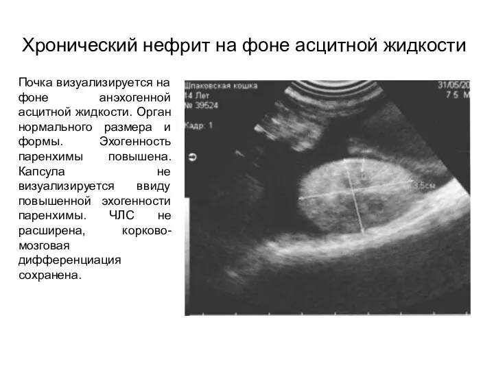 Хронический нефрит на фоне асцитной жидкости Почка визуализируется на фоне анэхогенной