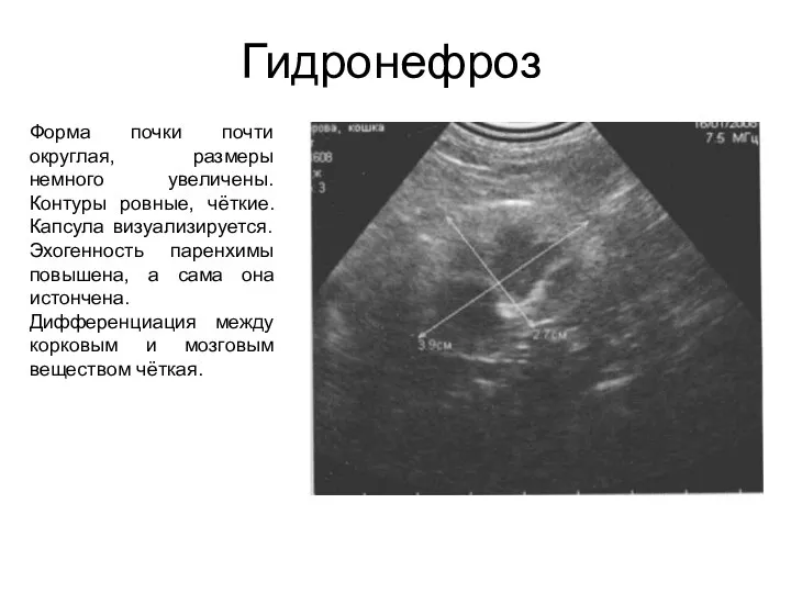 Гидронефроз Форма почки почти округлая, размеры немного увеличены. Контуры ровные, чёткие.