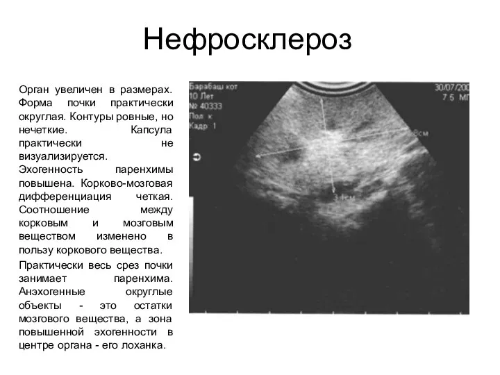 Нефросклероз Орган увеличен в размерах. Форма почки практически округлая. Контуры ровные,