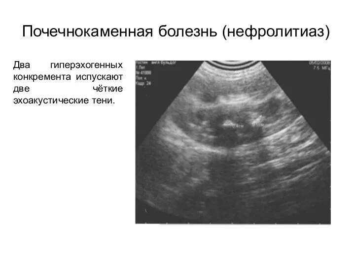 Почечнокаменная болезнь (нефролитиаз) Два гиперэхогенных конкремента испускают две чёткие эхоакустические тени.