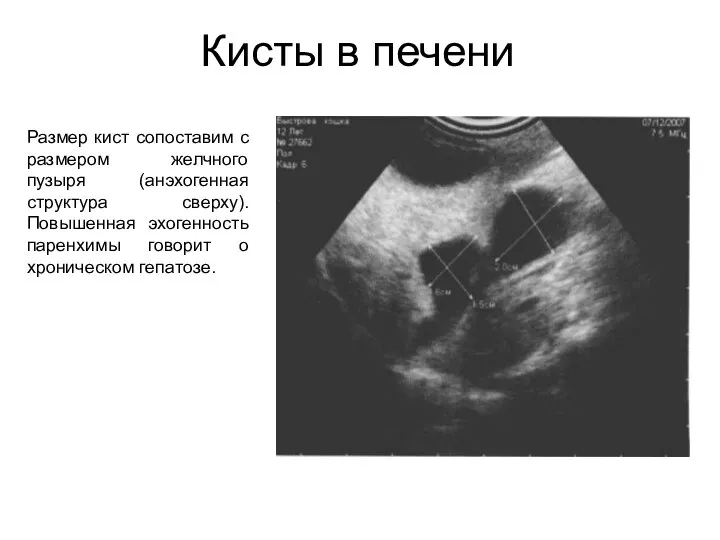 Кисты в печени Размер кист сопоставим с размером желчного пузыря (анэхогенная