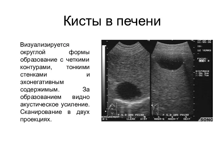 Кисты в печени Визуализируется округлой формы образование с четкими контурами, тонкими