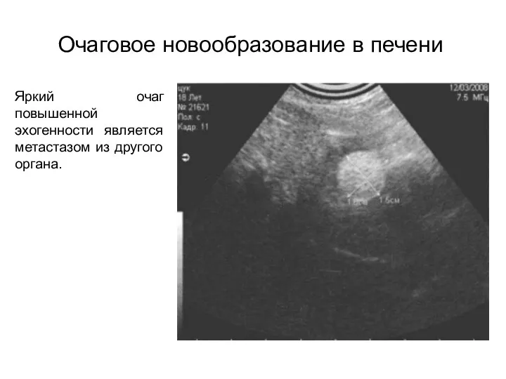 Очаговое новообразование в печени Яркий очаг повышенной эхогенности является метастазом из другого органа.