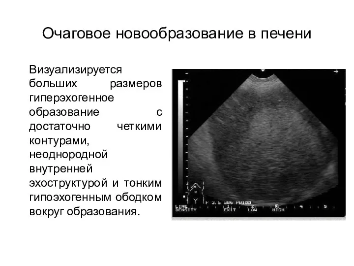 Очаговое новообразование в печени Визуализируется больших размеров гиперэхогенное образование с достаточно