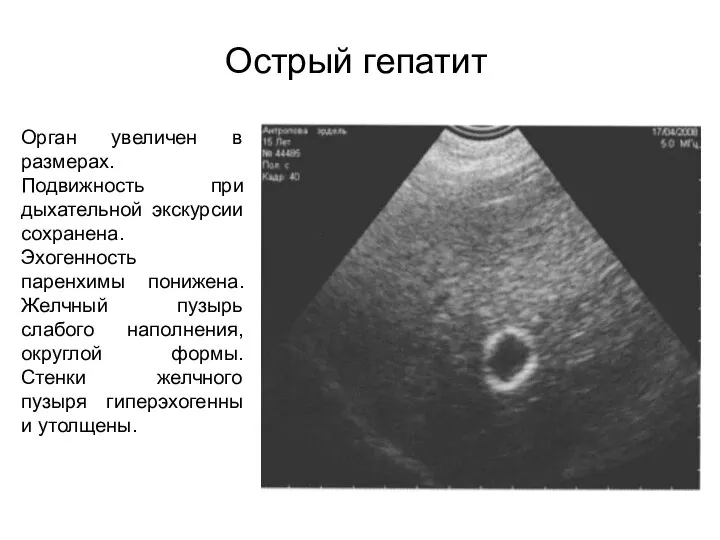 Острый гепатит Орган увеличен в размерах. Подвижность при дыхательной экскурсии сохранена.
