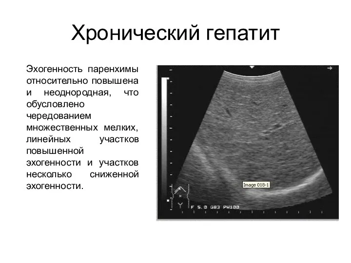 Хронический гепатит Эхогенность паренхимы относительно повышена и неоднородная, что обусловлено чередованием