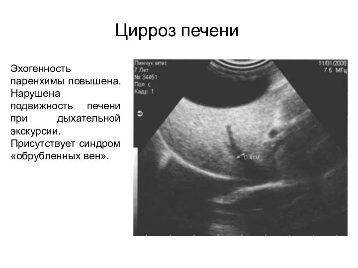 Цирроз печени Эхогенность паренхимы повышена. Нарушена подвижность печени при дыхательной экскурсии. Присутствует синдром «обрубленных вен».