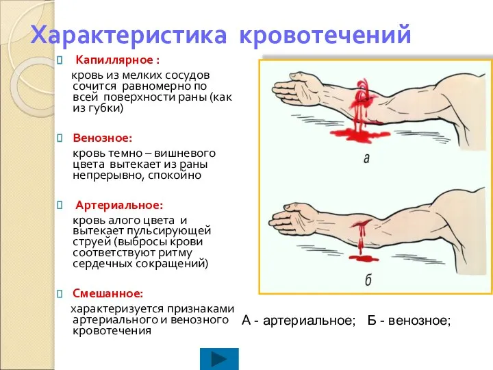 Характеристика кровотечений Капиллярное : кровь из мелких сосудов сочится равномерно по