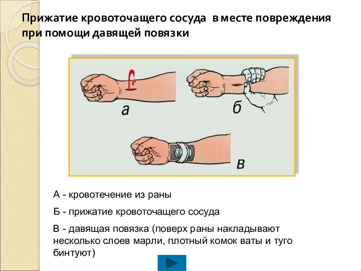 А - кровотечение из раны Б - прижатие кровоточащего сосуда В