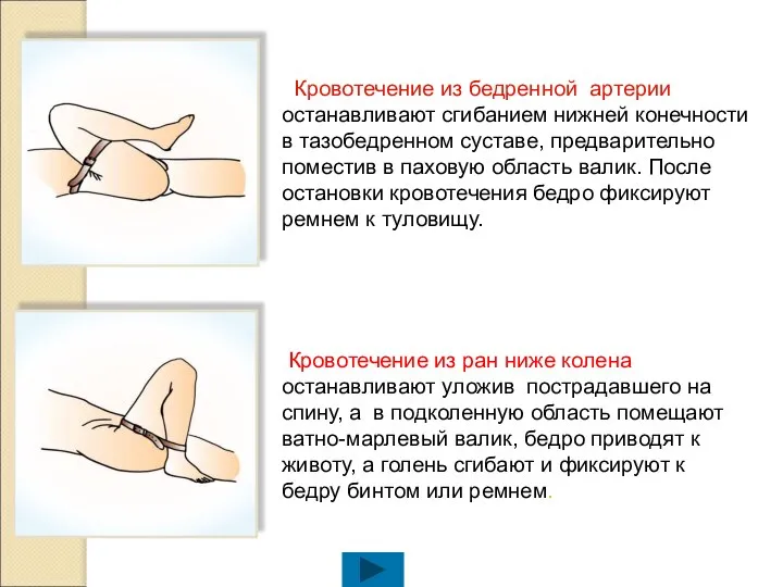 Кровотечение из бедренной артерии останавливают сгибанием нижней конечности в тазобедренном суставе,