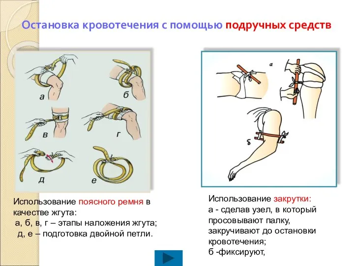 Остановка кровотечения с помощью подручных средств Использование поясного ремня в качестве