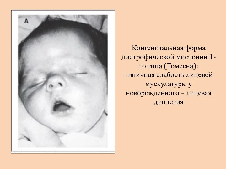Конгенитальная форма дистрофической миотонии 1-го типа (Томсена): типичная слабость лицевой мускулатуры у новорожденного – лицевая диплегия