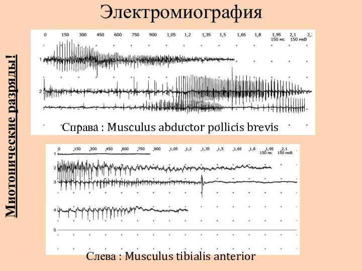 Электромиография Справа : Musculus abductor pollicis brevis Слева : Musculus tibialis anterior Миотонические разряды!