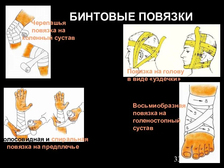 БИНТОВЫЕ ПОВЯЗКИ Восьмиобразная повязка на голеностопный сустав Черепашья повязка на коленный