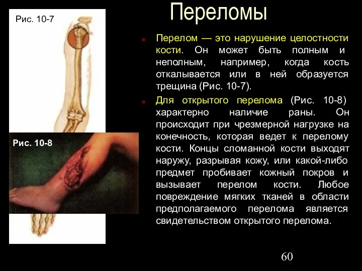 Переломы Перелом — это нарушение целостности кости. Он может быть полным