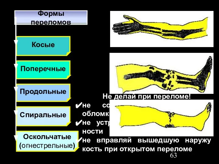 Поперечные Косые Спиральные Продольные Оскольчатые (огнестрельные) Формы переломов Не делай при