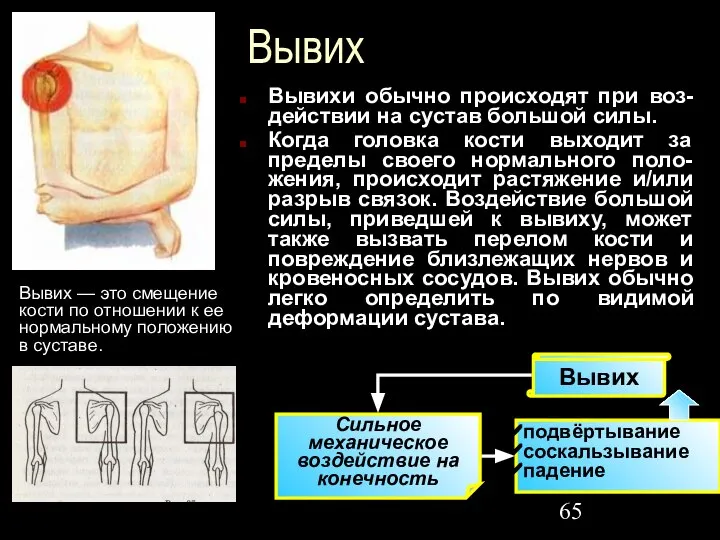 Вывих Вывихи обычно происходят при воз-действии на сустав большой силы. Когда