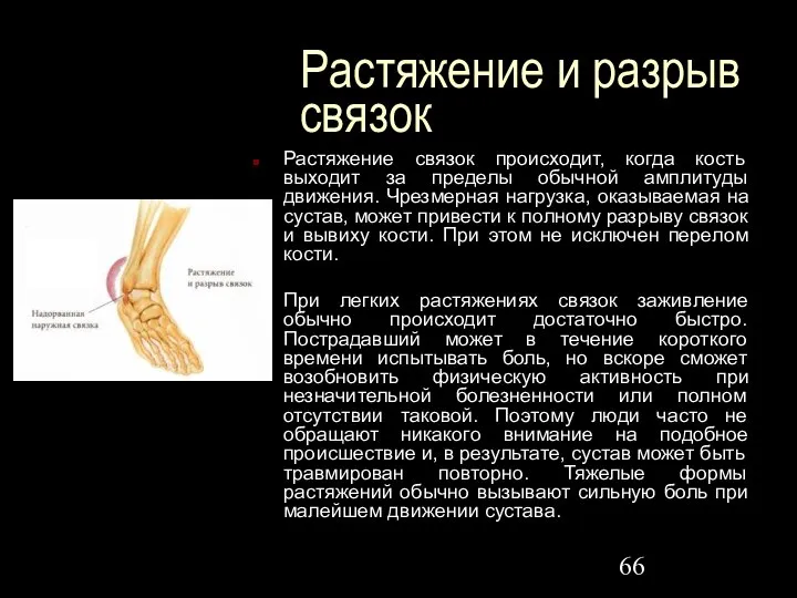 Растяжение и разрыв связок Растяжение связок происходит, когда кость выходит за