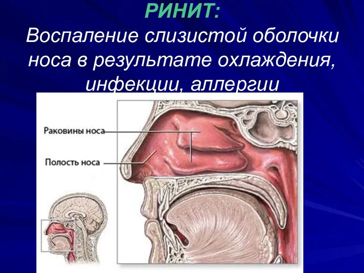 РИНИТ: Воспаление слизистой оболочки носа в результате охлаждения, инфекции, аллергии