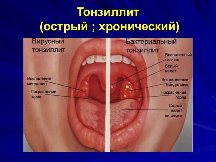 Тонзиллит (острый ; хронический)