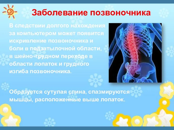 Заболевание позвоночника В следствии долгого нахождения за компьютером может появится искривление