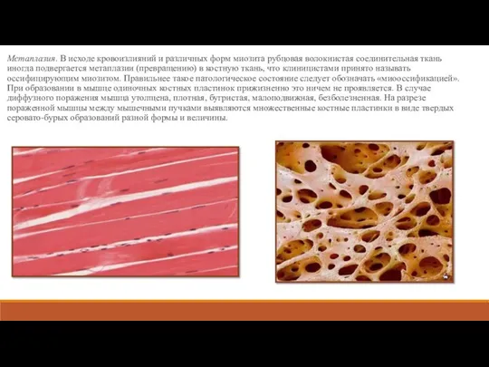 Метаплазия. В исходе кровоизлияний и различных форм миозита рубцовая волокнистая соединительная