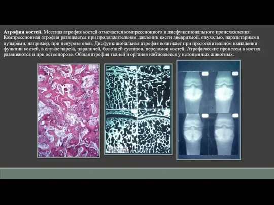 Атрофия костей. Местная атрофия костей отмечается компрессионного и дисфункционального происхождения. Компрессионная