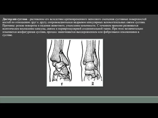 Дисторзия сустава - растяжение его вследствие кратковременного неполного смещения суставных поверхностей