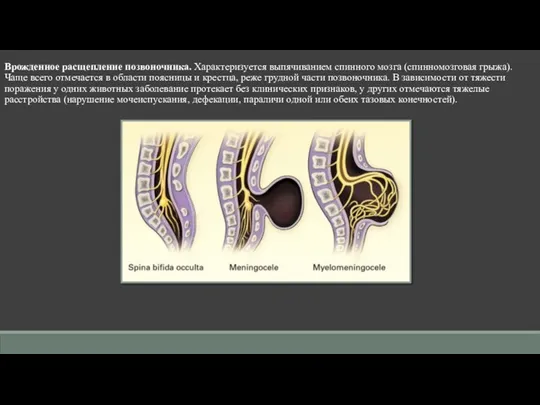 Врожденное расщепление позвоночника. Характеризуется выпячиванием спинного мозга (спинномозговая грыжа). Чаще всего