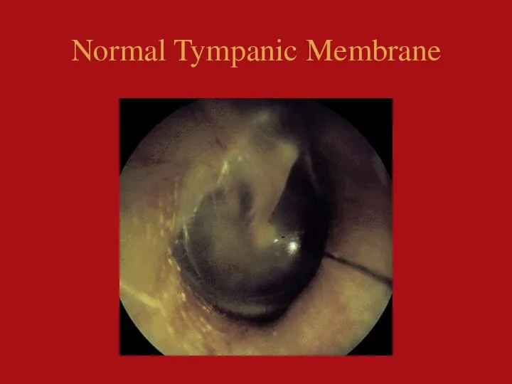 Normal Tympanic Membrane