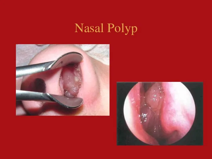 Nasal Polyp