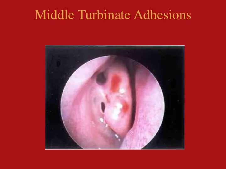 Middle Turbinate Adhesions